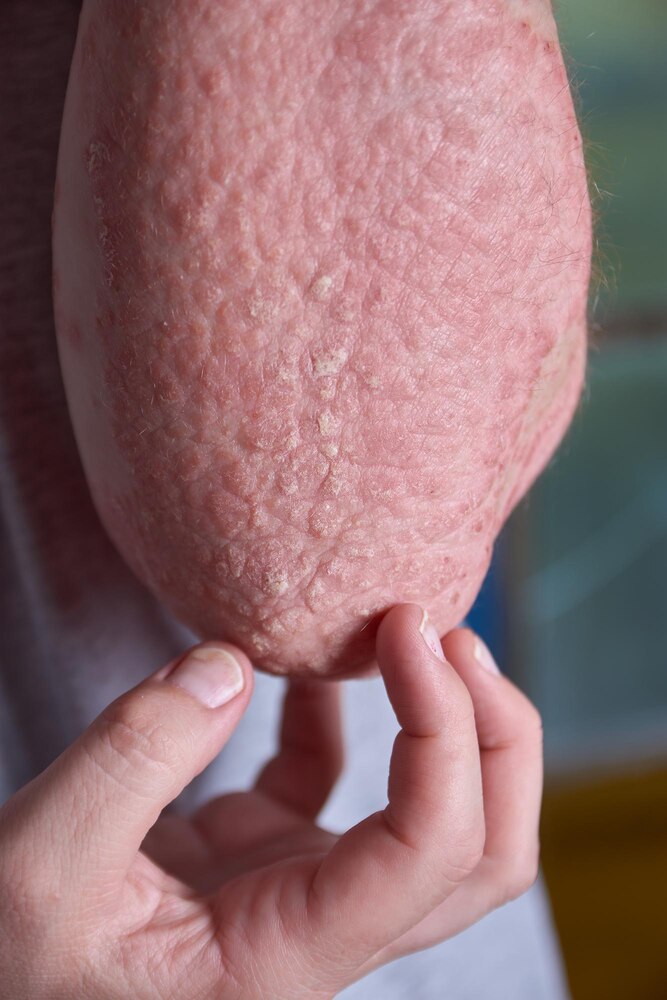 Forearm view with Psoriasis